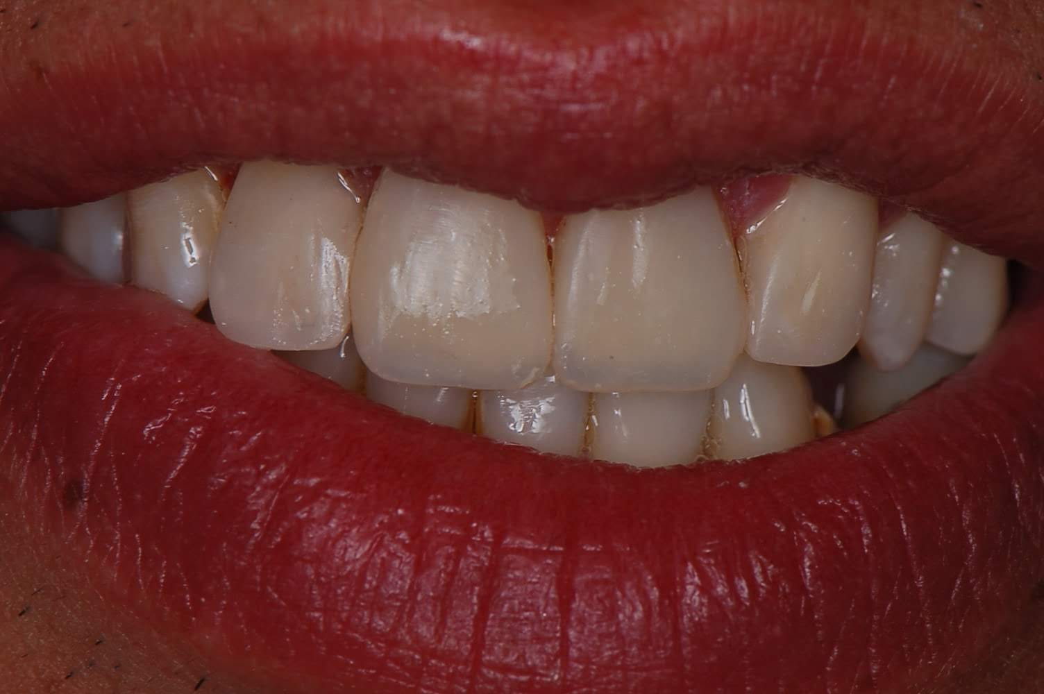 Prótese Dentária — resultado do tratamento